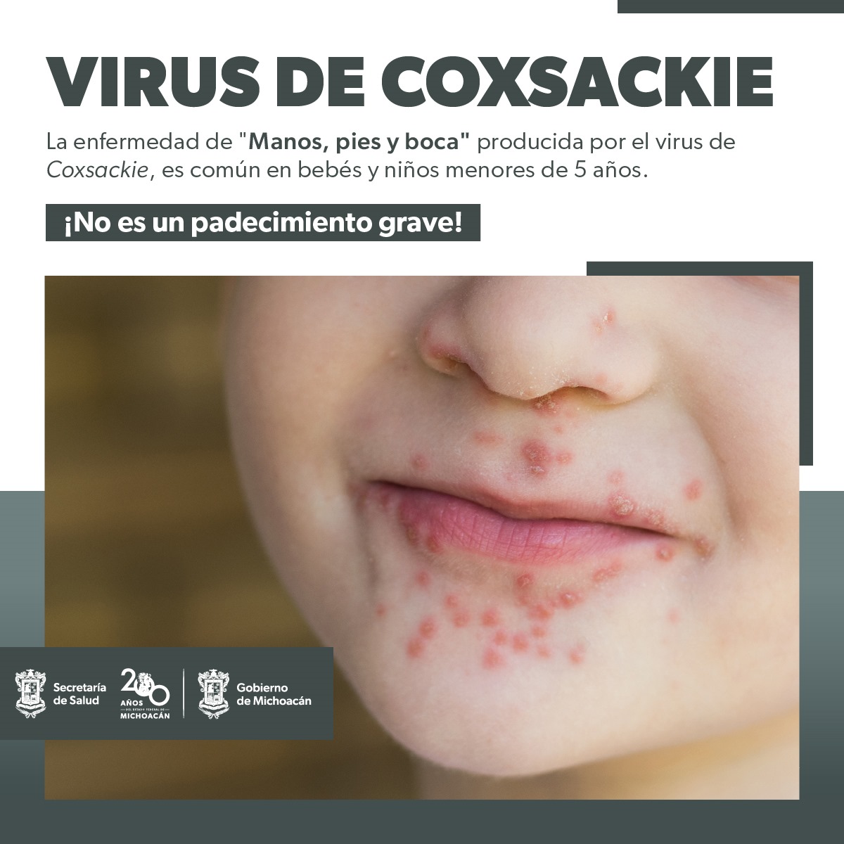 Conoce cómo prevenir el virus coxsackie que afecta a menores de 5 años