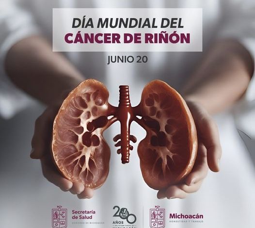 Conoce los síntomas del cáncer de riñón para detectarlo a tiempo: SSM