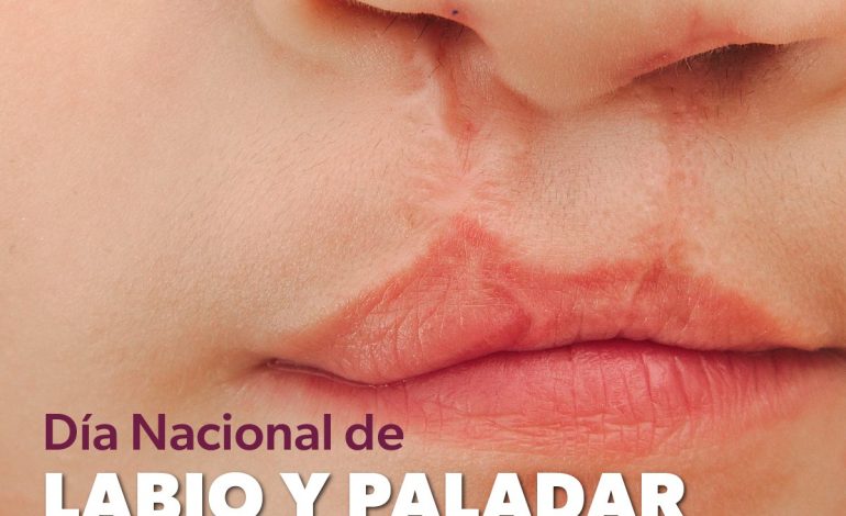 SSM previene y atiende el labio y paladar hendido