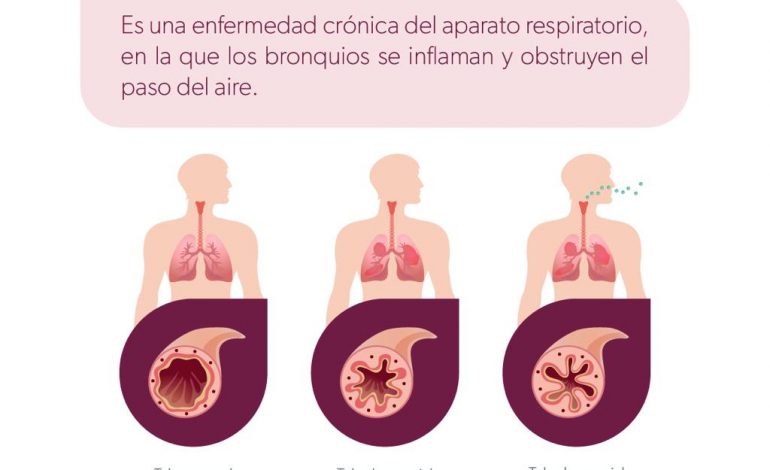 En temporada invernal cuídate del asma con estas recomendaciones de la SSM