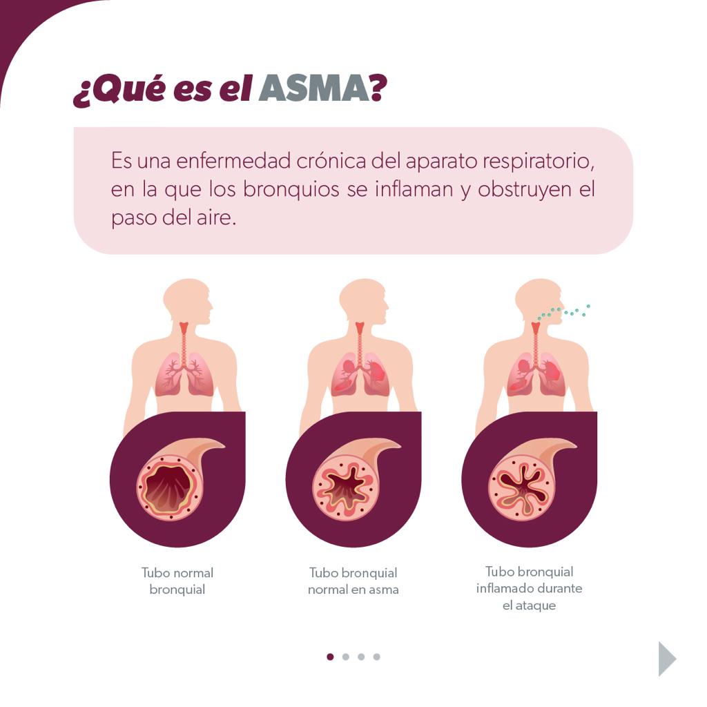 En temporada invernal cuídate del asma con estas recomendaciones de la SSM