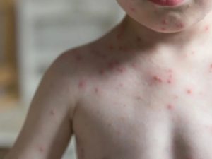 Confirma SSM primeros casos de sarampión en Michoacán