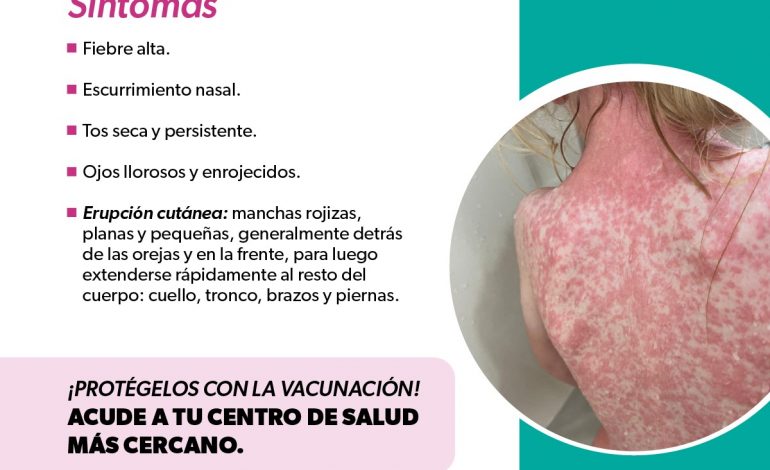 Identifica los síntomas del sarampión y protege tu salud: SSM