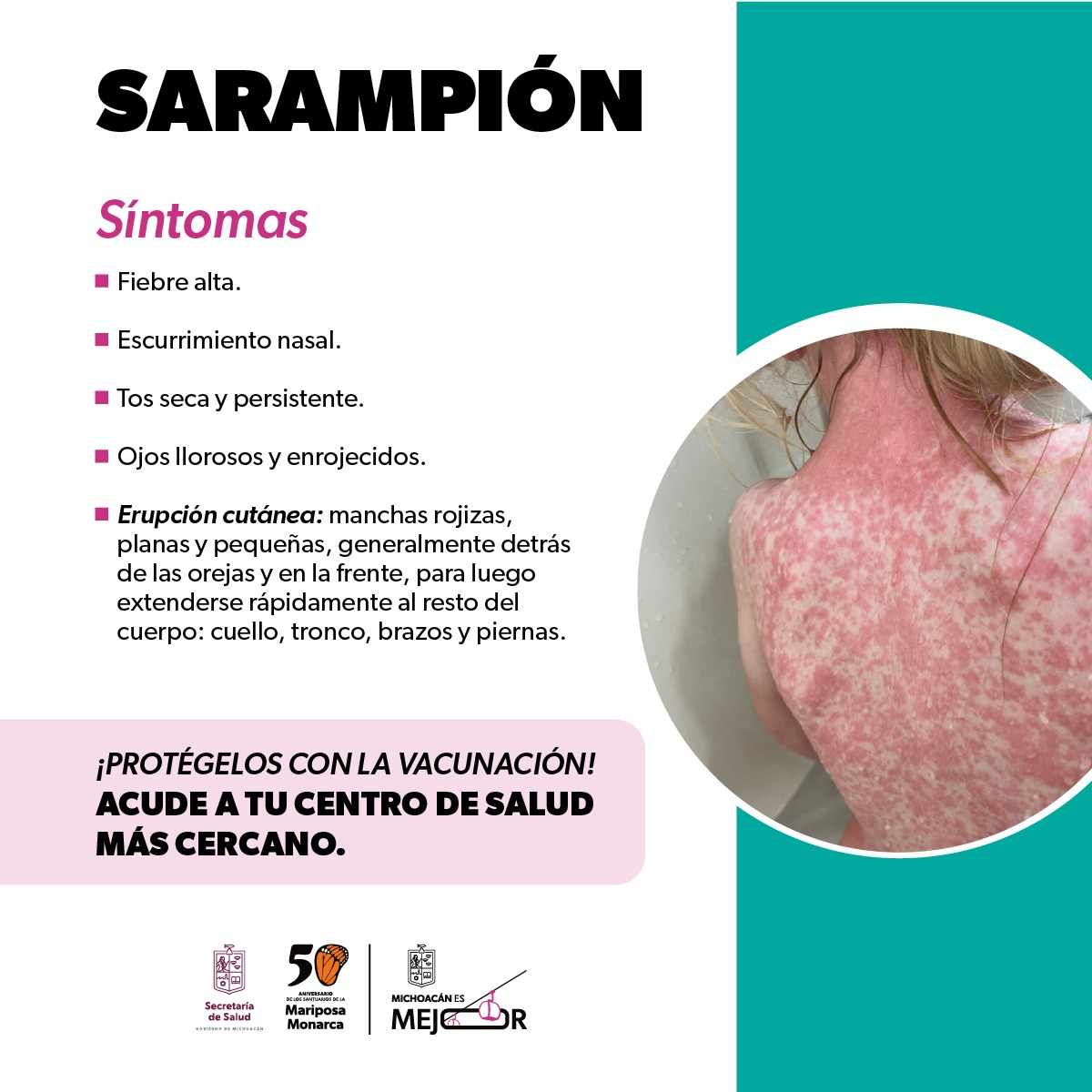 Identifica los síntomas del sarampión y protege tu salud: SSM - El Clarín
