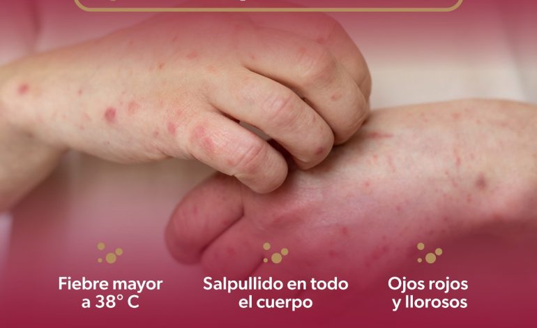 ¡No bajes la guardia! Ese sarpullido podría ser sarampión, aprende a identificarlo: SSM