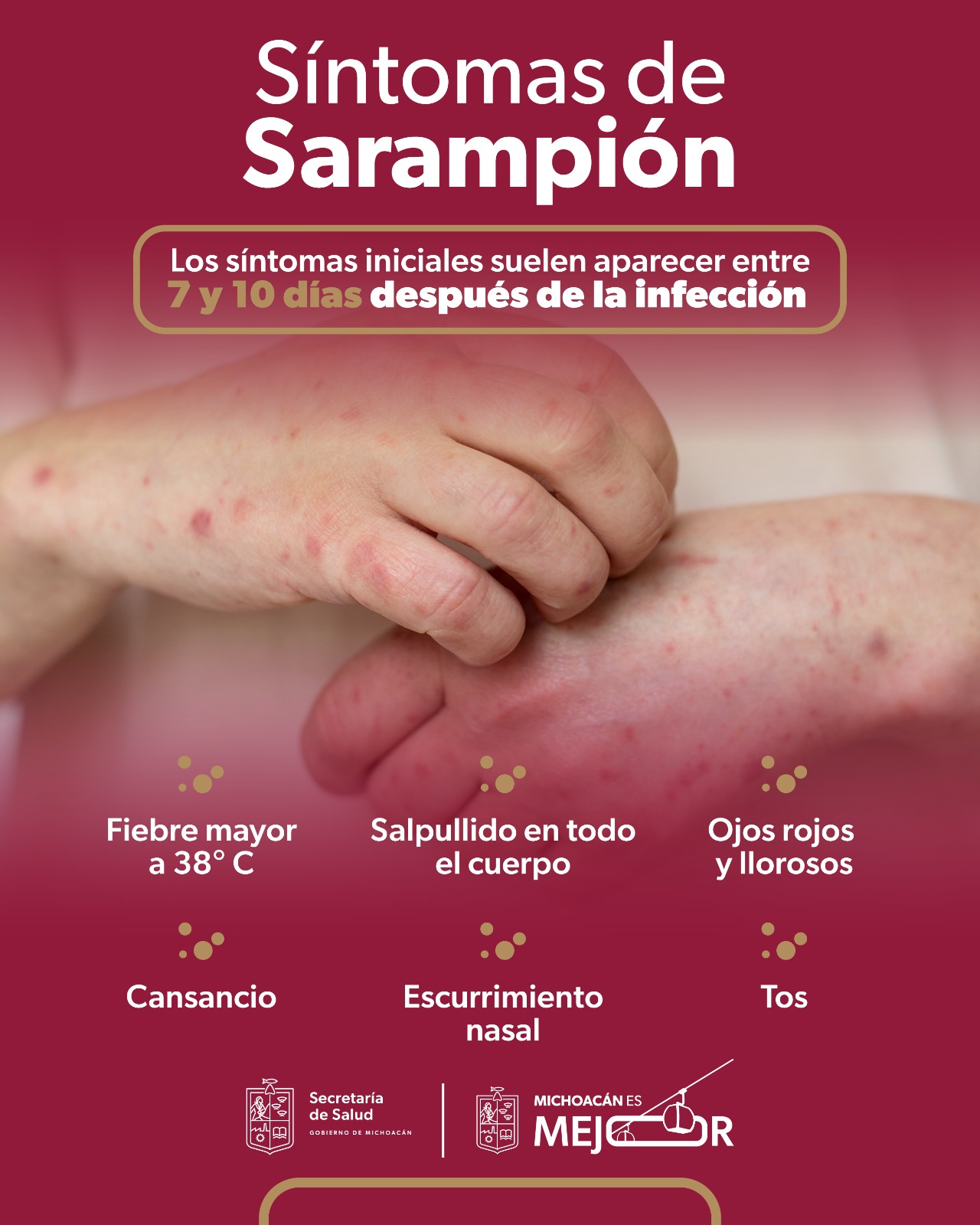 ¡No bajes la guardia! Ese sarpullido podría ser sarampión, aprende a identificarlo: SSM